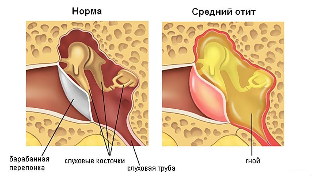 Кровь из уха при хроническом отите