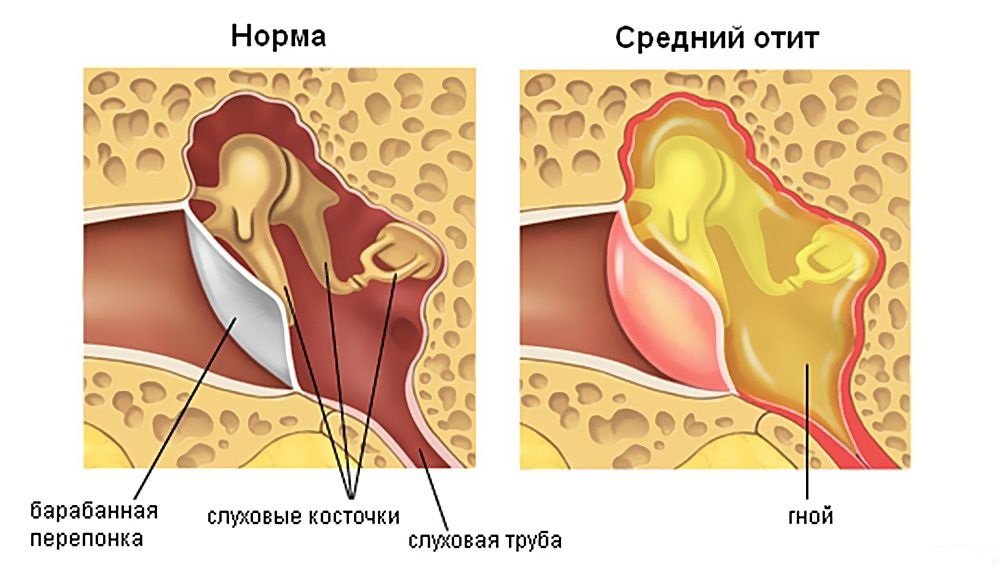 Гнойный отит что это и чем грозит