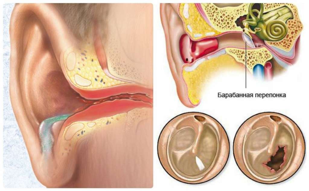 Гнойный отит среднего уха у взрослых операция