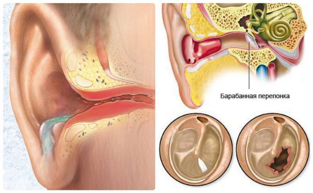 Гнойный отит при нарушенной перепонке