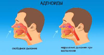 Аденоиды