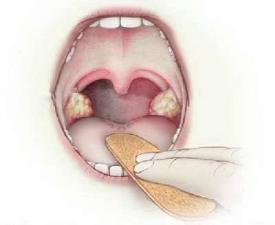 Пробки в миндалинах