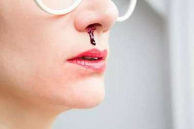 Причины и лечение кровотечений из носа