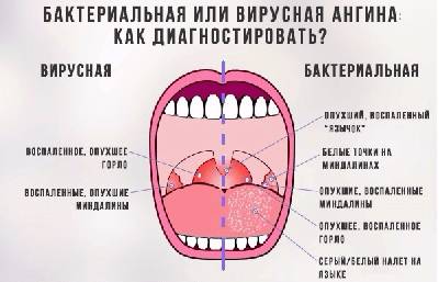 Вирусная ангина у детей