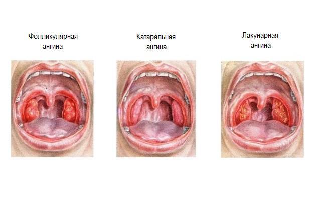 Виды Ангины Фото