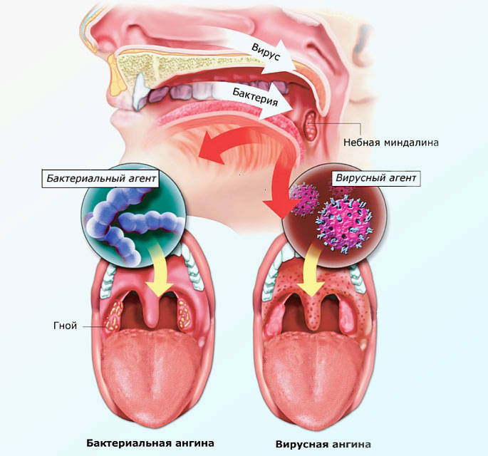 virusnaya-angina-u-detey-2-3.jpg