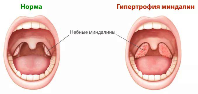 Как Выглядит Ангина Фото