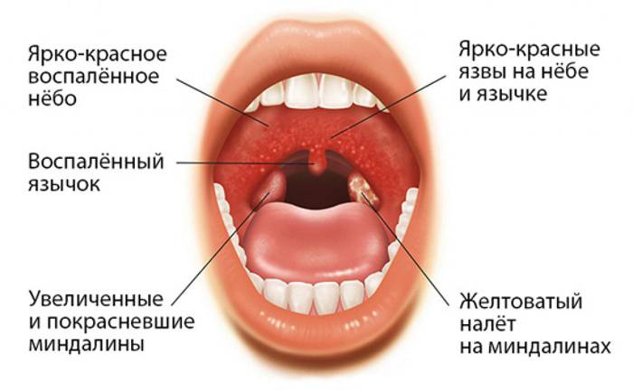 Как Выглядит Ангина Фото