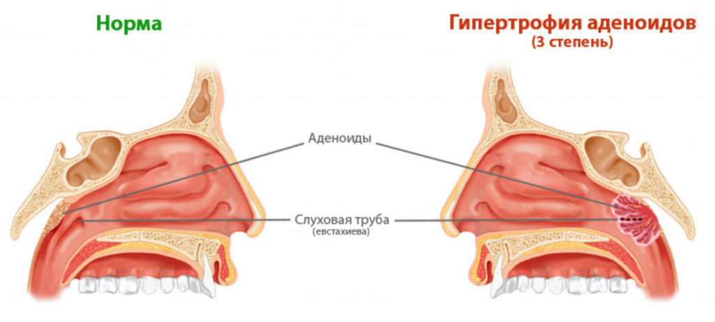 гипертрофия аденоидов