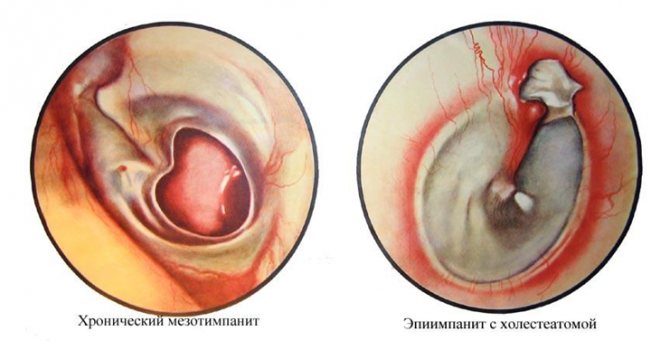 formy-hronicheskogo-gnojnogo-srednego-otita.jpg