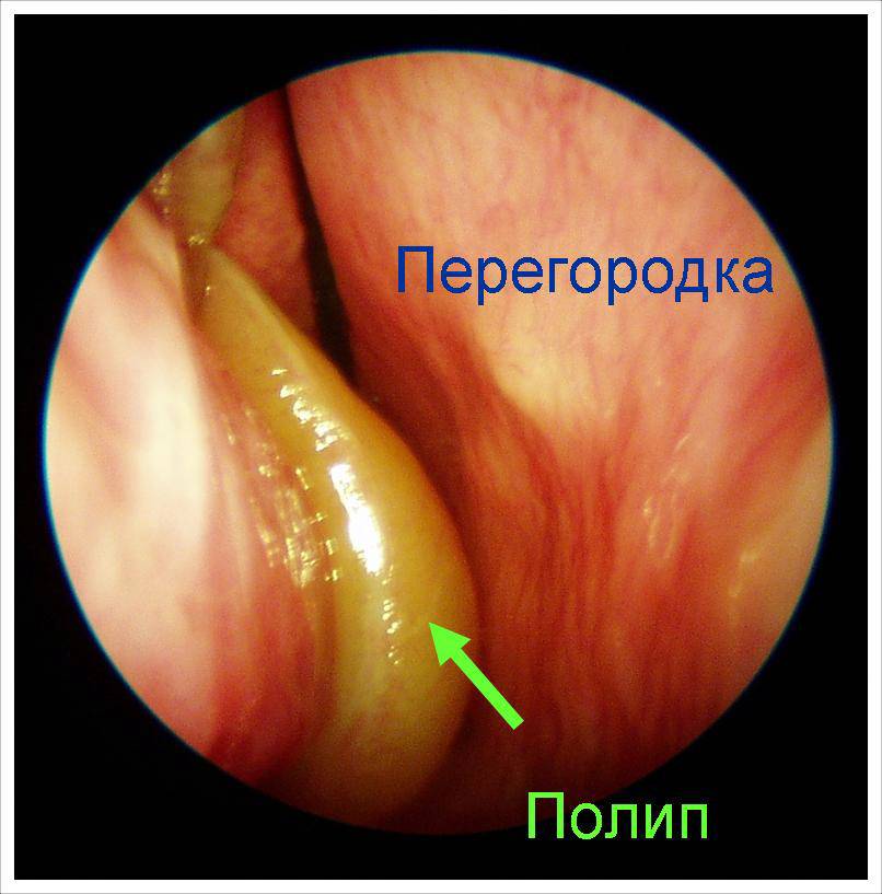 Полип в носу (полипозный риносинусит) - симптомы и лечение