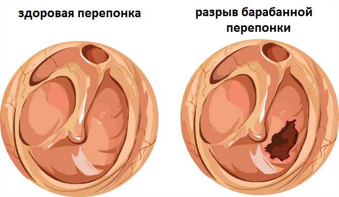 perforasiya-barabannoy-pereponki.jpg