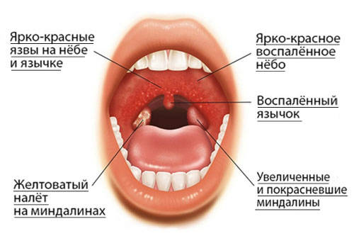 Как Выглядит Ангина Фото