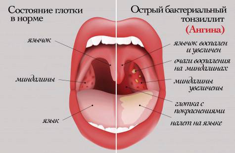 Как Выглядит Гнойная Ангина Фото