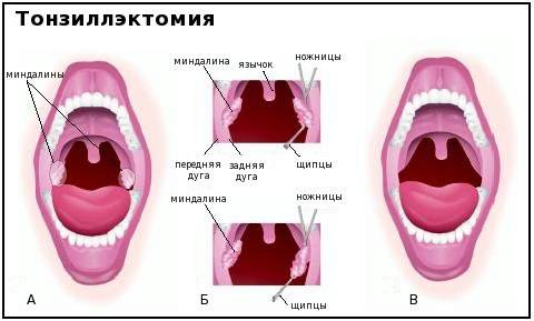 Тонзилитные Камни Фото