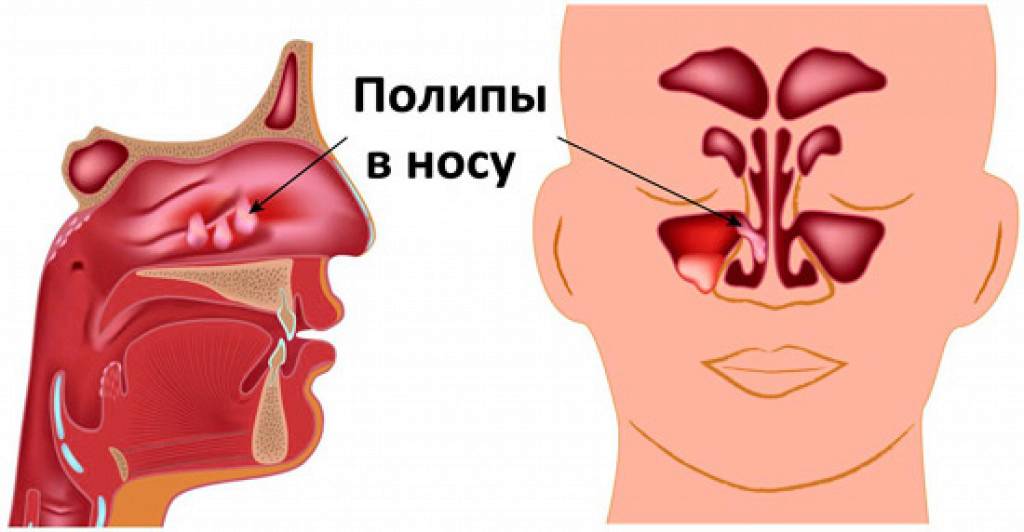 height="500px" Полипы в носу