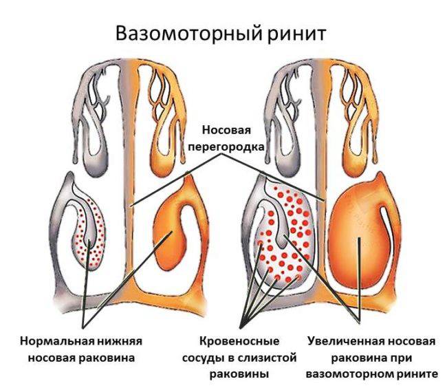 вазомоторный ринит вазомоторный ринит